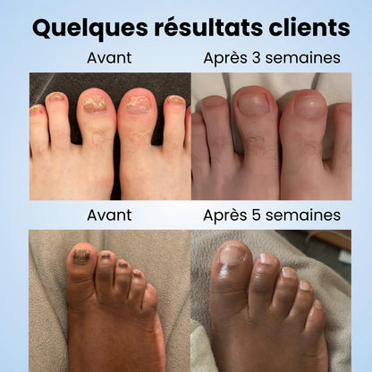Orvenia - Fungal Nail Patches