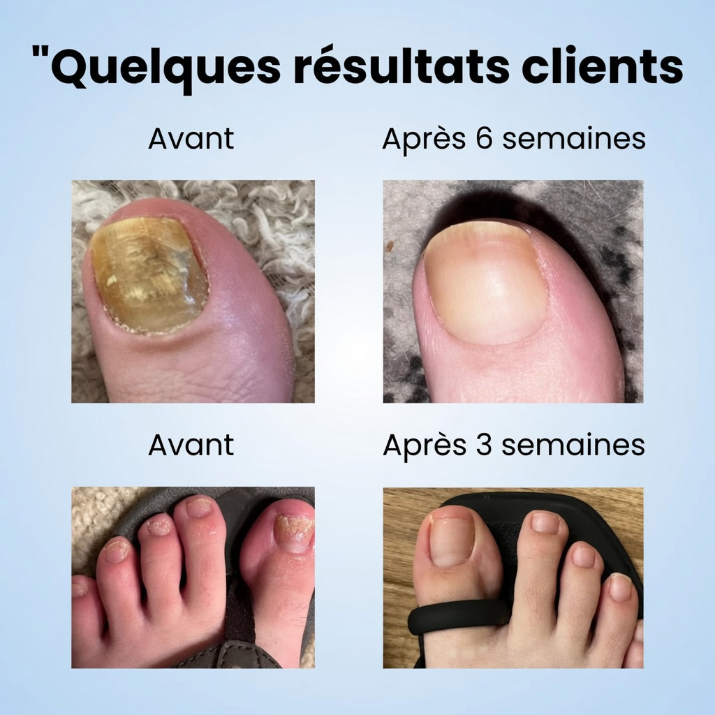 Orvenia - Fungal Nail Patches